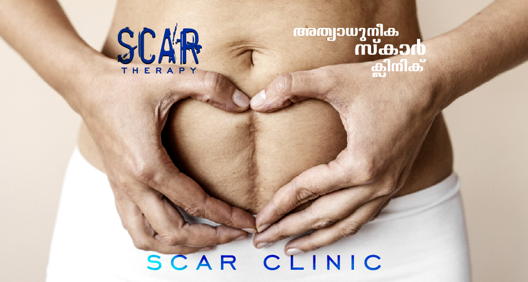 Lisa skin clinic, Calicut, Scar Therapy